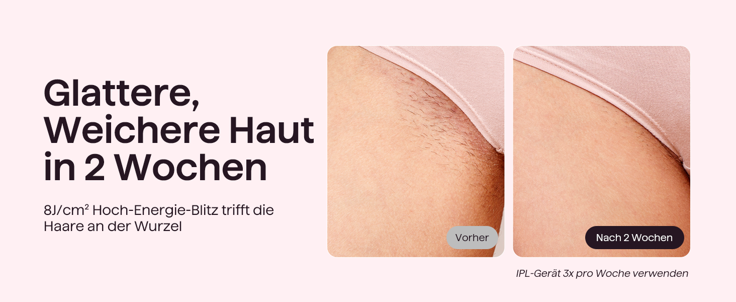 IPL пристрій для епіляції Wavytalk: безболісна епіляція для жінок та чоловіків, 24J, охолодження, збреєром, для обличчя, тіла, бікіні