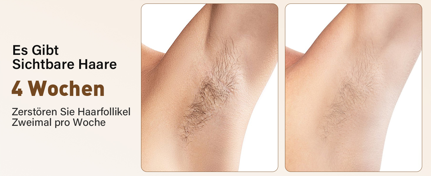 Пристрій для епіляції IPL з лазером та охолодженням, 3 функції (HR/SC/RA), 9 рівнів енергії, 999 999 імпульсів, для чоловіків/жінок/обличчя/бікіні/тіла (білий)