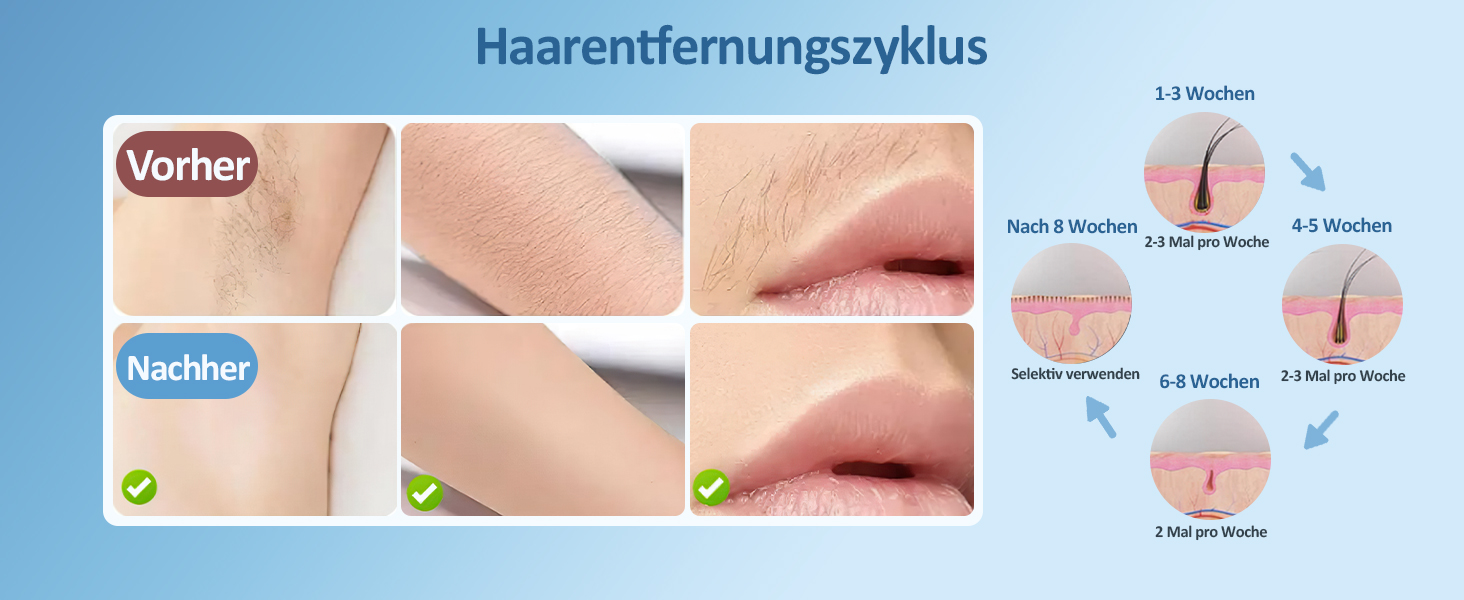 Пристрій для епіляції IPL з охолодженням та 999 999 імпульсів світла – лазерний епілятор з 5 рівнями енергії, для жінок/чоловіків/ногів/бікіні