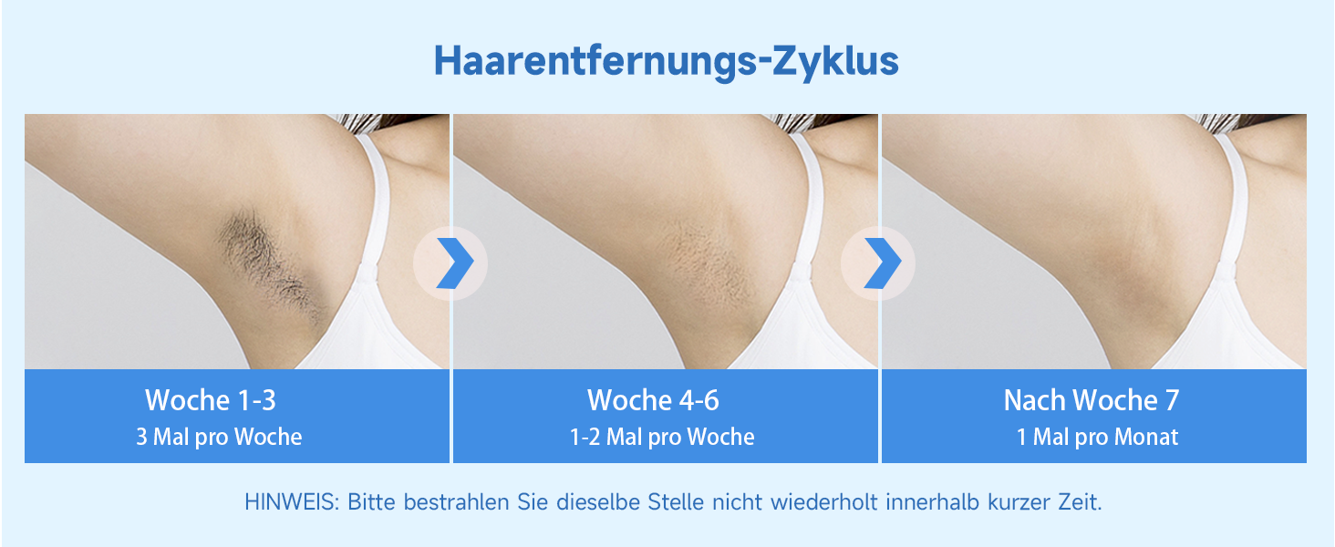 Пристрій для епіляції IPL MLAY: Швидка та безболісна епіляція лазером для обличчя, тіла та зони бікіні (для чоловіків та жінок)