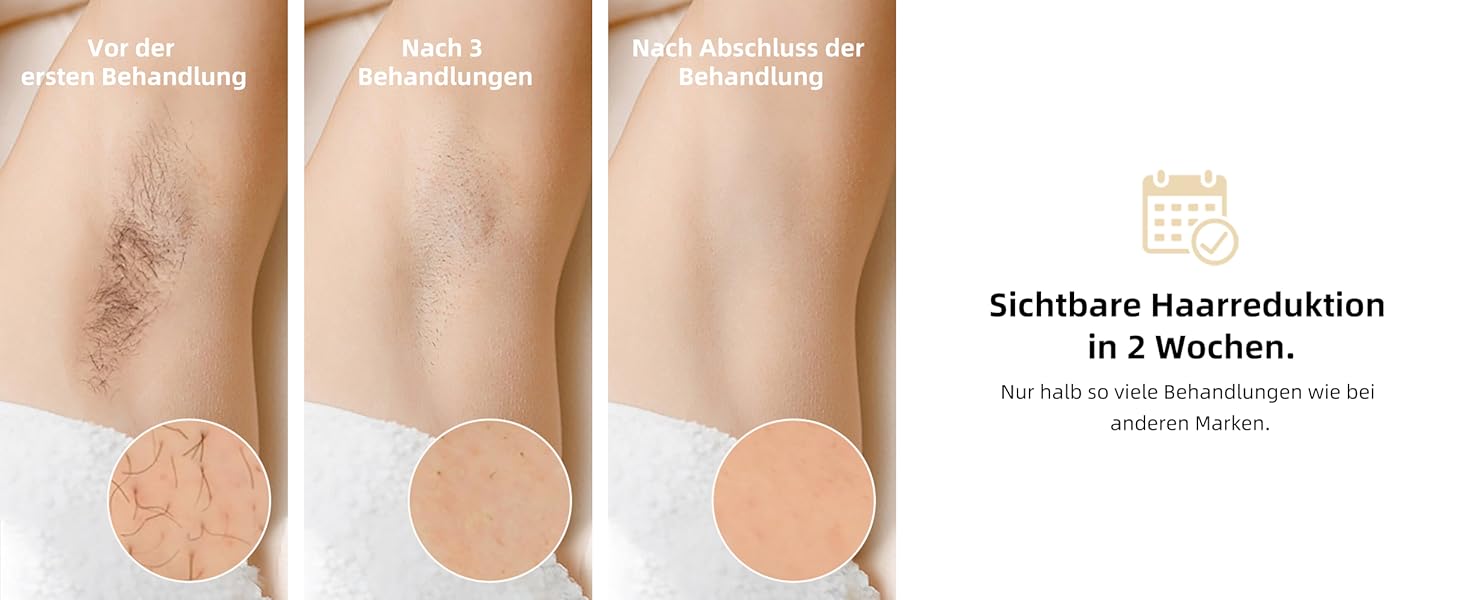 Пристрій для епіляції IPL з охолодженням 6°C, безболісна епіляція для тіла та обличчя, 999 900 імпульсів, 9 рівнів потужності, для тіла, обличчя, зони бікіні