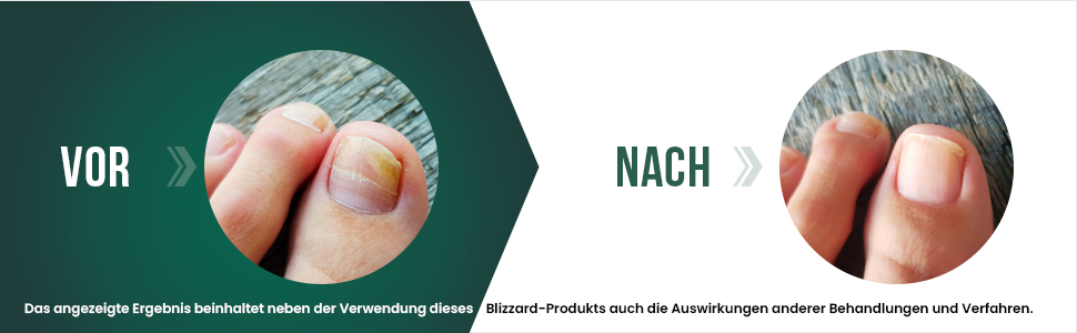 Професійний інструмент для педикюру: щипці для видалення врослих та товстих нігтів, з пилочкою, з нержавіючої сталі, 15 см