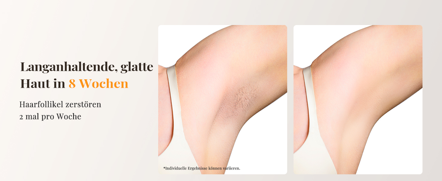 Пристрій для епіляції IPL з охолодженням, 9 рівнів потужності, 999900 імпульсів світла, безболісна епіляція вдома для обличчя, тіла, пахв та ніг (білий)