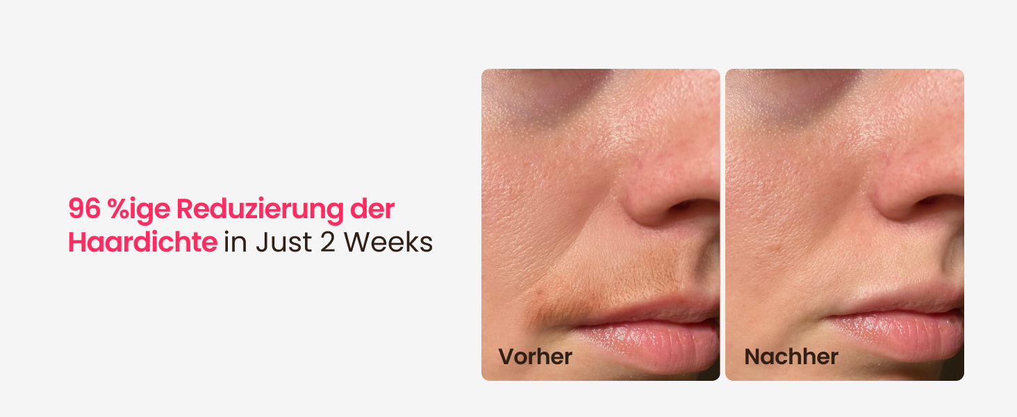 Пристрій для епіляції IPL з потрійним імпульсом, 12 см², охолодження сапфіровим льодом, лазерна епіляція для жінок та чоловіків, 3°C для безболісної та довготривалої епіляції вдома для обличчя, бікіні, інтимної зони (Champagne Gold)