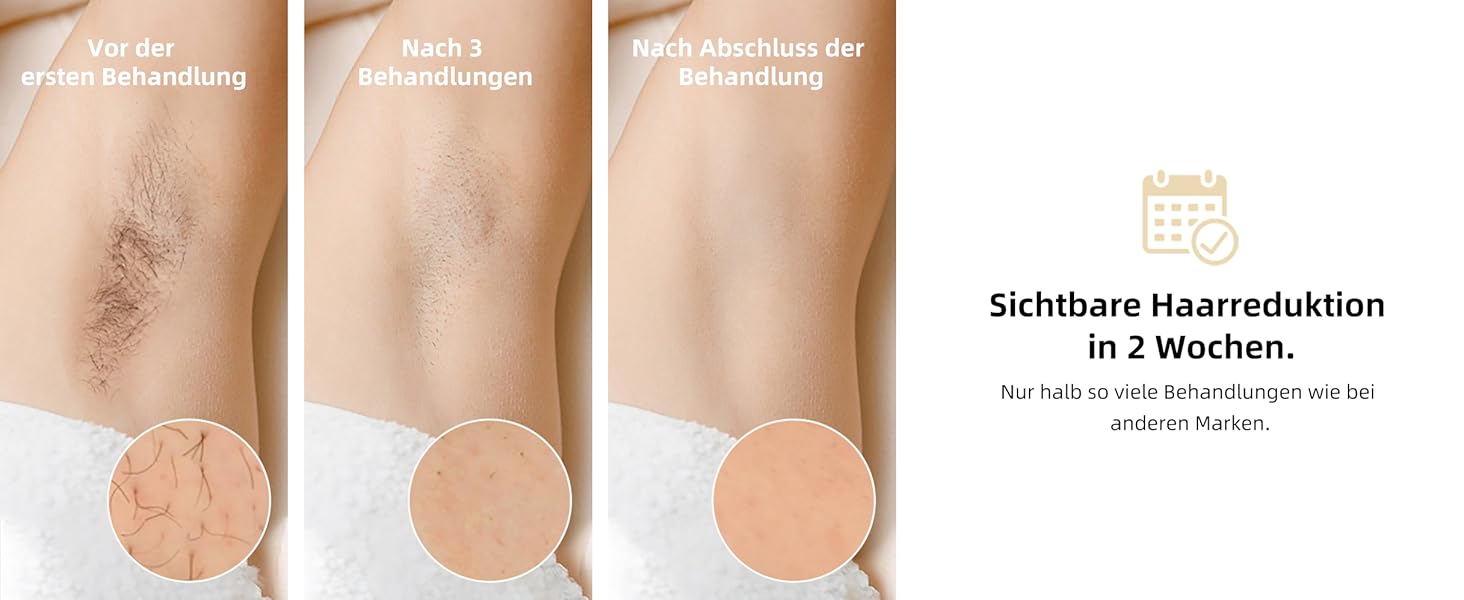 Пристрій для епіляції IPL з охолодженням 6°C, безболісна епіляція для тіла та обличчя, 999,900 імпульсів, 9 рівнів потужності, білий