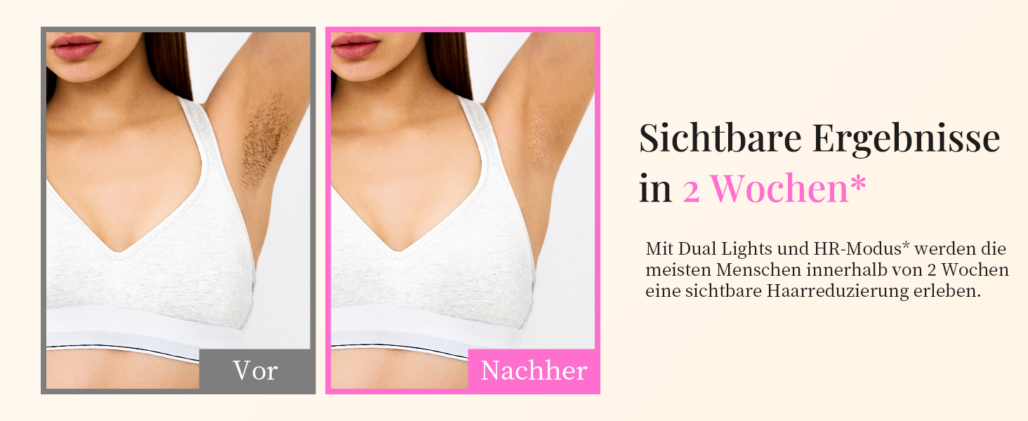 Пристрій для епіляції IPL Haarlosy - безболісна епіляція лазером, для дому, 9 рівнів, захист шкіри, для жінок та чоловіків, для обличчя, бікіні, тіла, білий (рожевий)